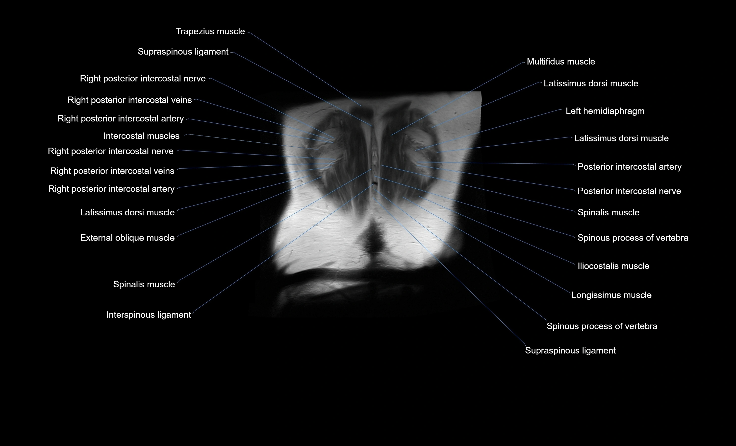 MRI Abdomen coronal labelled cross sectional anatomy radiology  image-img-00001-00055.webp